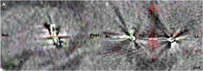 Stimulation-Induced Side Effects of Deep Brain Stimulation in the Ventralis Intermedius and Posterior Subthalamic Area for Essential Tremor